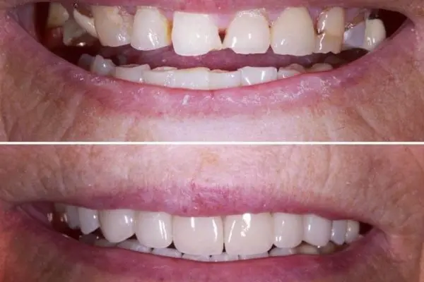 Multiple Veneers