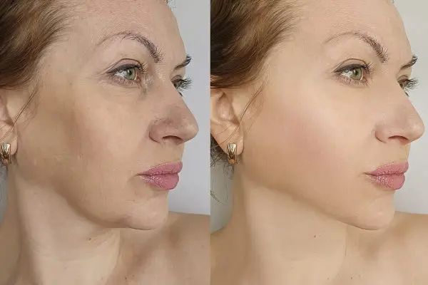 woman face wrinkles before and after treatment