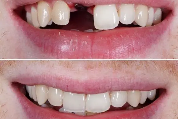Single Tooth Implant