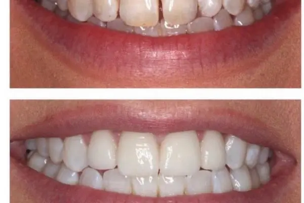 Smile Makeover