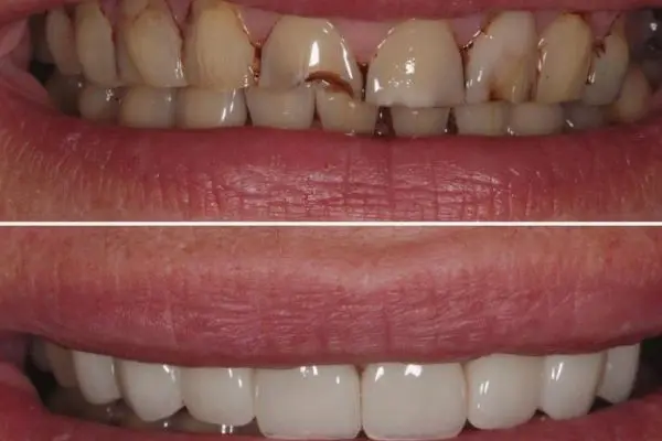 Veneers